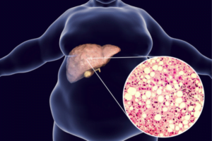 Maintaining a healthy weight for fatty liver disease